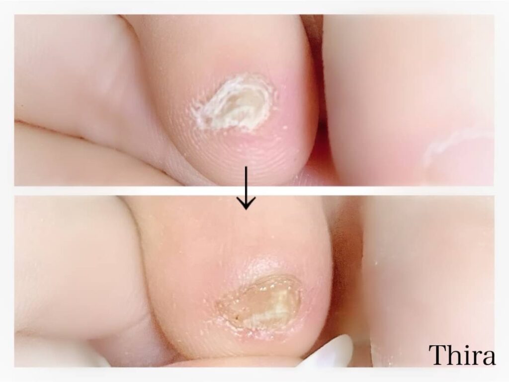 正しい足爪カットケアのビフォーアフター。小指の爪。