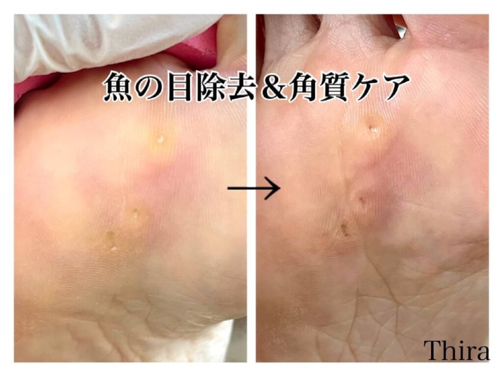うおの目除去&角質ケアのビフォーアフター。